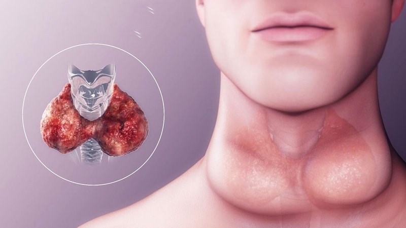 Ung thư tuyến giáp di căn hạch cổ: Dấu hiệu và cách điều trị 3