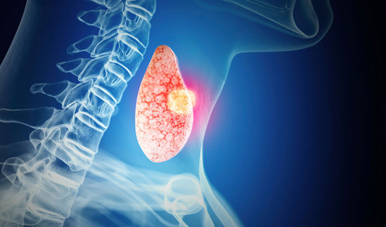 Ung thư tuyến giáp di căn hạch cổ: Dấu hiệu và cách điều trị 1