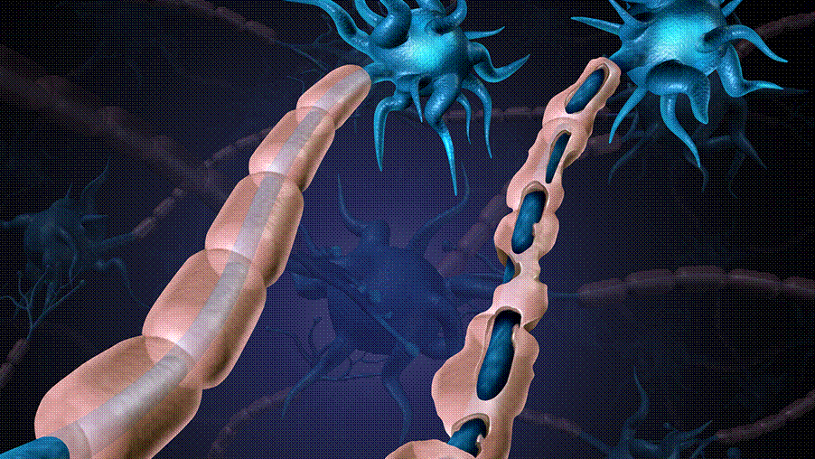 Viêm tủy cắt ngang: Nguyên nhân, triệu chứng và phương pháp điều trị 2