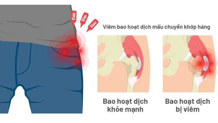 Viêm bao hoạt dịch khớp háng là bệnh gì? Cách điều trị bệnh hiệu quả 2
