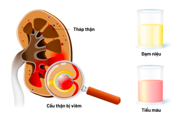 Viêm cầu thận cấp ở trẻ em và tất cả những điều cần biết 1.png