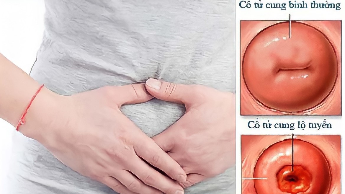 Ra huyết trắng màu nâu: Nguyên nhân và cách phòng tránh 5