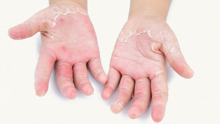 Thuốc á sừng được lựa chọn sử dụng nhiều nhất hiện nay 1