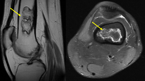 Nhồi máu xương là gì? Nguyên nhân và phương pháp điều trị bệnh 1