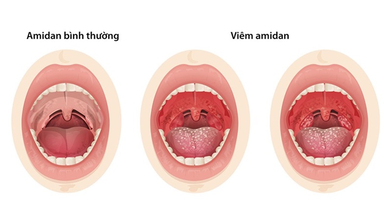Amidan sưng to: Nguyên nhân, phân loại và giải pháp can thiệp 2