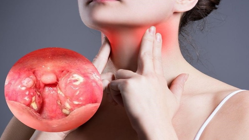 Amidan sưng to: Nguyên nhân, phân loại và giải pháp can thiệp 5