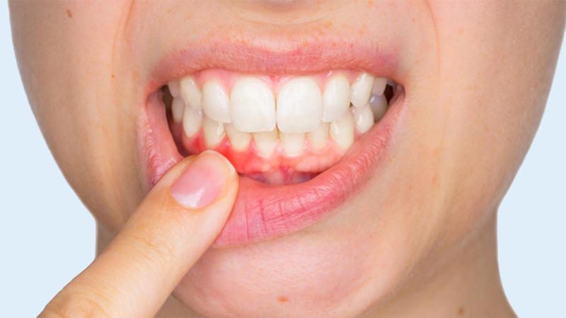 Ăn đồ ngọt bị chua miệng do nguyên nhân gì? Làm sao xử lý? 1