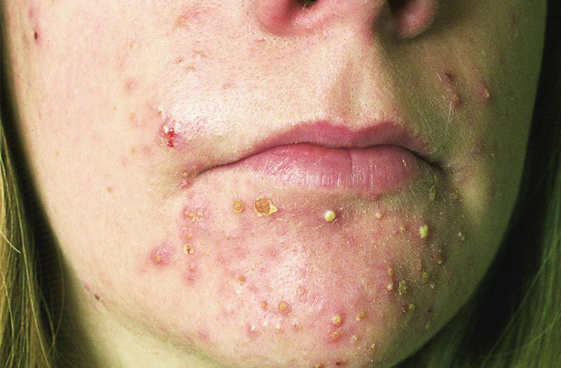 Ăn lựu có bị mụn không? Bí quyết thưởng thức lựu không lo mụn 4