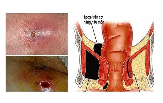 Áp xe cạnh hậu môn: Nguyên nhân, triệu chứng và điều trị 1