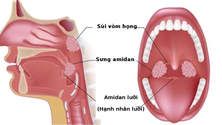 Áp xe quanh amidan 01