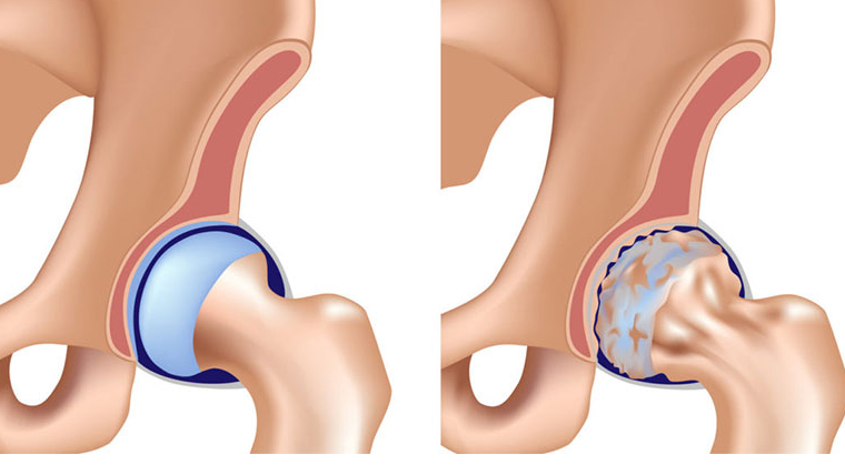 AVN là gì? Vì sao người bệnh bị AVN và cách điều trị căn bệnh này 1