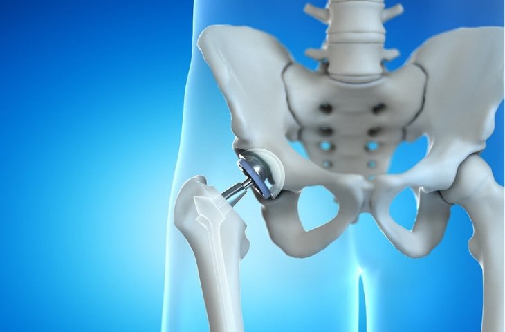 AVN là gì? Vì sao người bệnh bị AVN và cách điều trị căn bệnh này 3