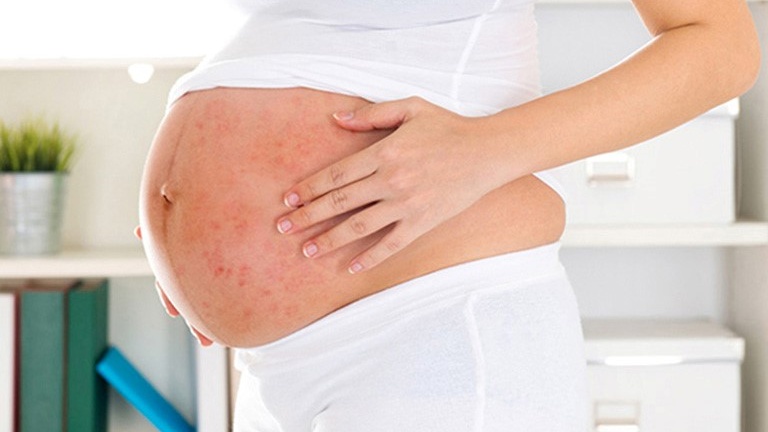 Bà bầu bị viêm nang lông – Nguyên nhân, triệu chứng và cách điều trị 1