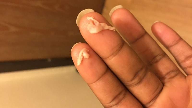 Bà bầu ra khí hư màu trắng đục vón cục có sao không? 2