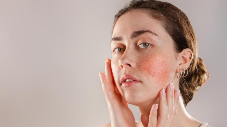 Ba mẹ thắc mắc vết chàm có di truyền không? 1