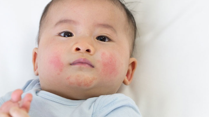 Ba mẹ thắc mắc vết chàm có di truyền không? 2