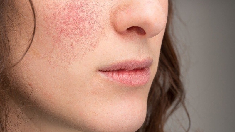 Ba mẹ thắc mắc vết chàm có di truyền không? 3