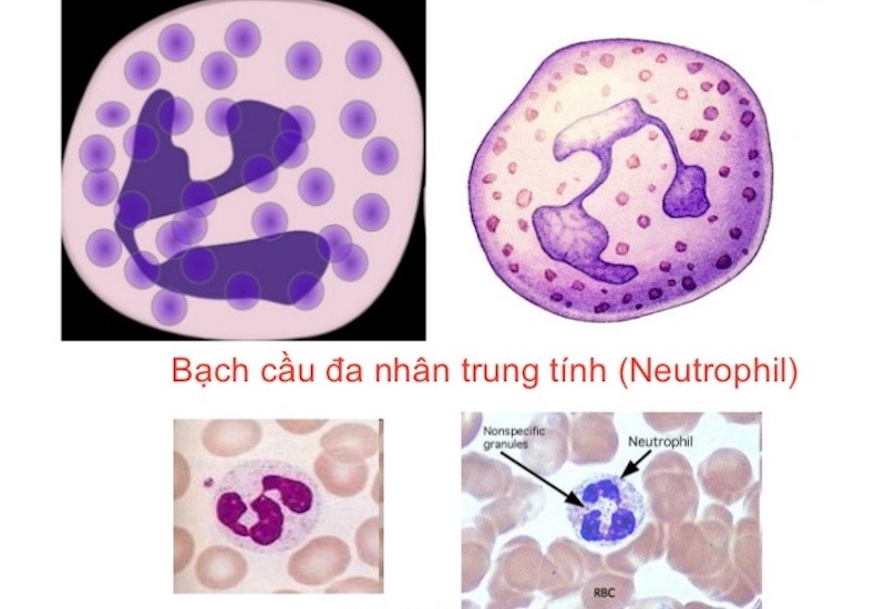 Bạch cầu đa nhân trung tính gây ra vấn đề sức khỏe nào? 2