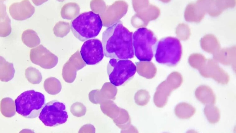 Bạch cầu đa nhân trung tính gây ra vấn đề sức khỏe nào?