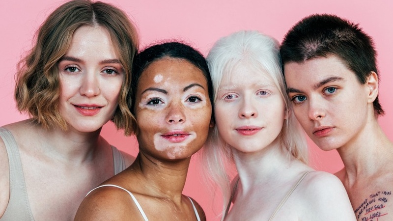 Bạch tạng có di truyền không? Sự thật bất ngờ mà bạn cần biết 1