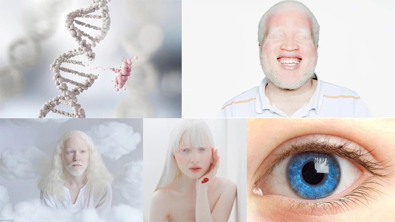 Bạch tạng có di truyền không? Sự thật bất ngờ mà bạn cần biết 2