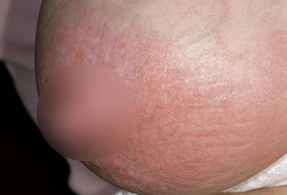 Áp xe vú có mủ có nguy hiểm không? Cách điều trị ra sao? 1