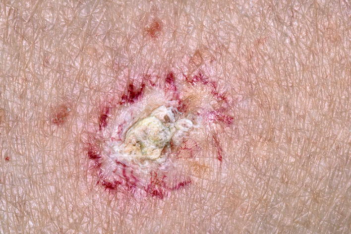 Bệnh Bowen: Ung thư tế bào vảy khu trú ở da 1