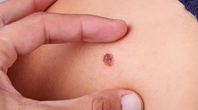 Bệnh Bowen: Ung thư tế bào vảy khu trú ở da 2