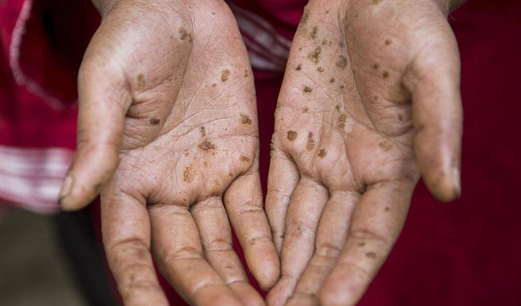 Bệnh Bowen: Ung thư tế bào vảy khu trú ở da 3