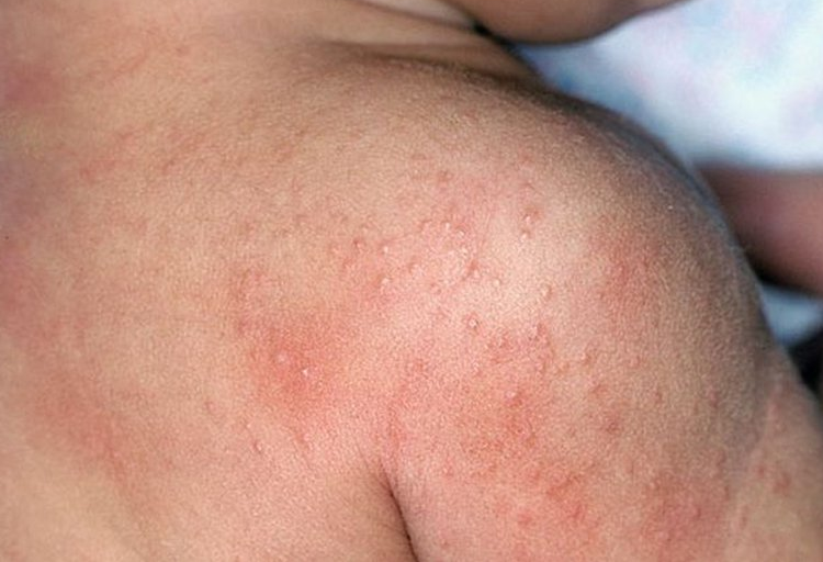 Bệnh Herpangina: Đường lây truyền, triệu chứng, chẩn đoán, điều trị 3