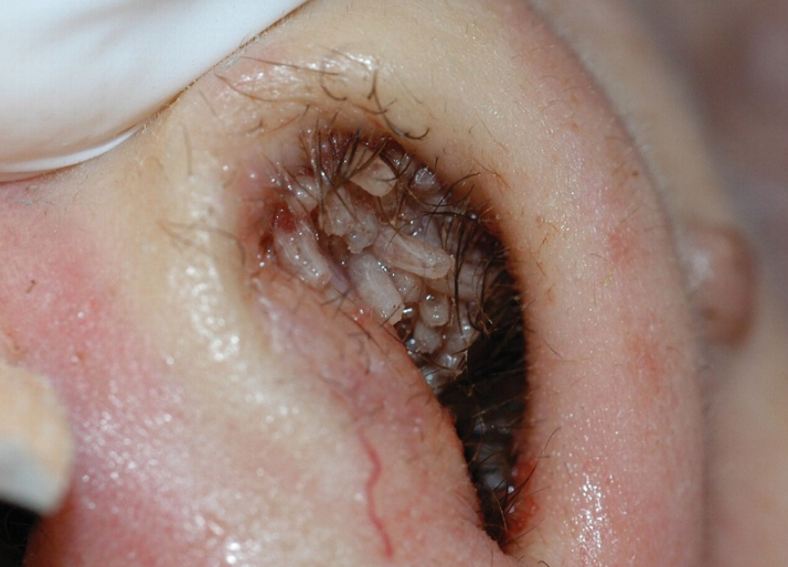 Bệnh nhiễm giòi Maggot: Nguyên nhân, triệu chứng, điều trị và phòng chống 3