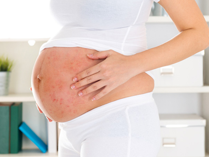 Bệnh zona thần kinh có ảnh hưởng đến thai nhi không? 2