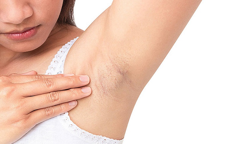 Bị bỏng do máy triệt lông: Nguyên nhân, triệu chứng và cách khắc phục 2