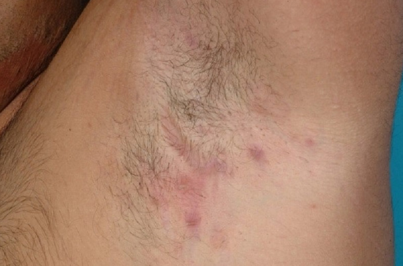 Bị bỏng do máy triệt lông: Nguyên nhân, triệu chứng và cách khắc phục 4