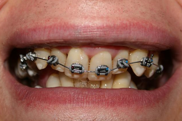 Bọc răng sứ có phải nhổ răng không? Những trường hợp ngoại lệ cần lưu ý 2