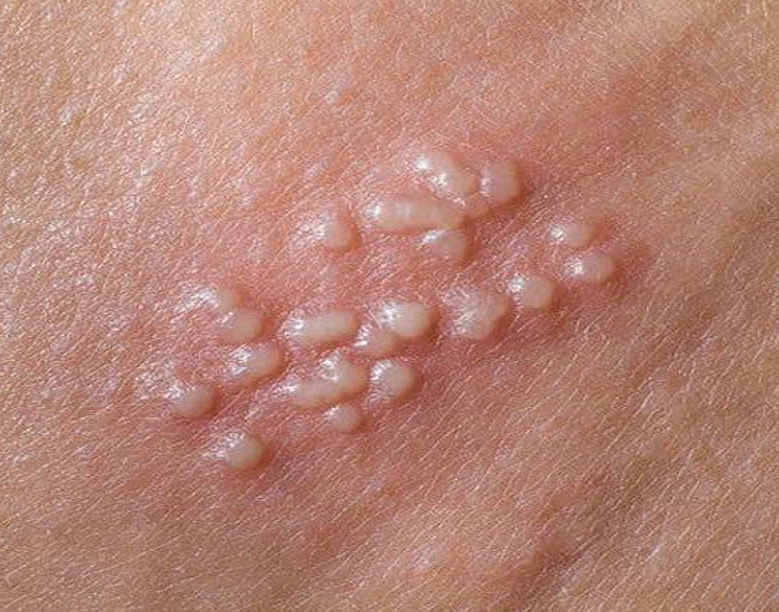 Cách đào thải virus HPV ra khỏi cơ thể triệt để 2