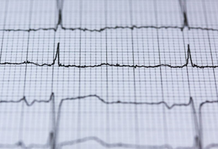 Cách mắc điện tim, gắn điện cực cho máy đo điện tim 1