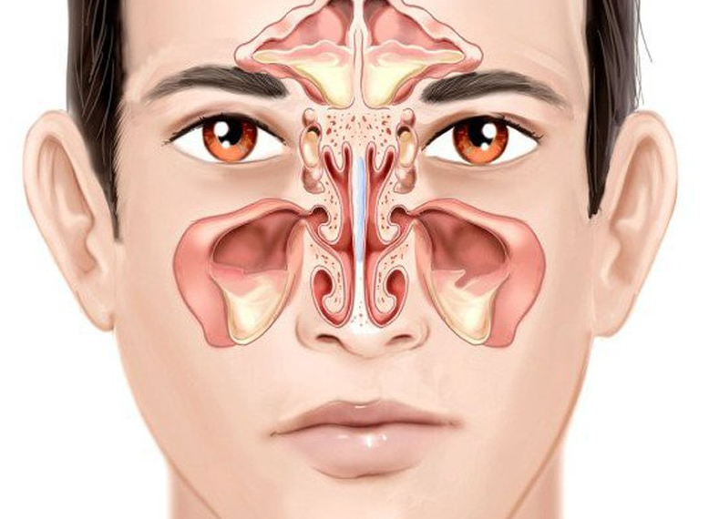 Cách nhận biết các triệu chứng viêm xoang nặng và biến chứng nguy hiểm 1