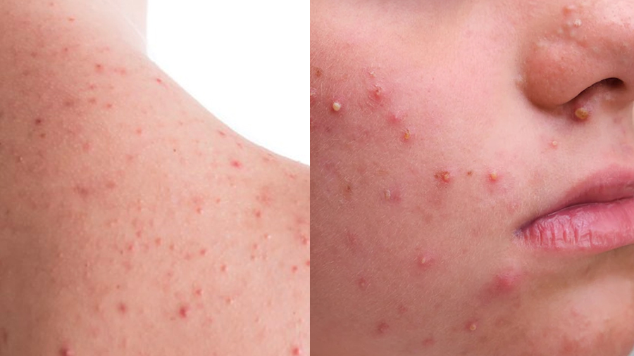 Mụn cơ thể và viêm nang lông ngày nóng không giống nhau