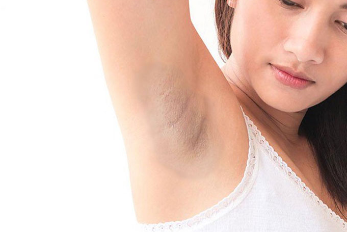 Cách trị thâm nách trong 3 ngày 1