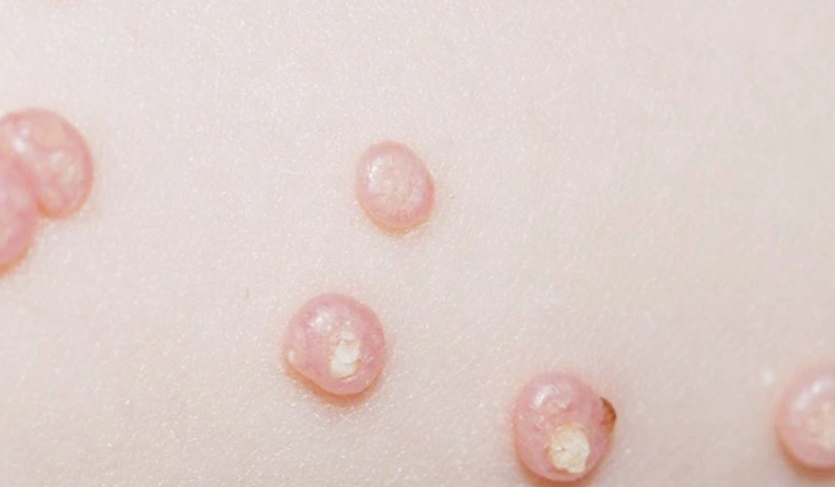 Cậu nhỏ nổi mụn trắng không ngứa là hiện tượng gì? 1