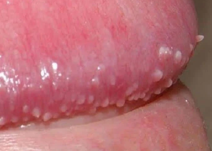 Cậu nhỏ nổi mụn trắng không ngứa là hiện tượng gì? 2