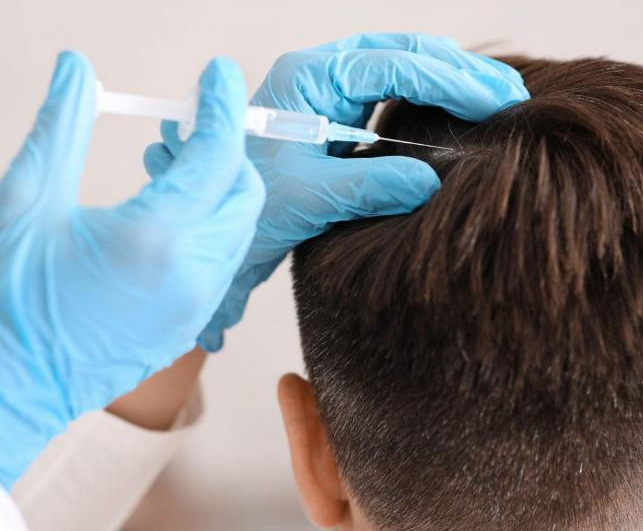 Cấy tóc sinh học là gì? Có nên thực hiện không? 4