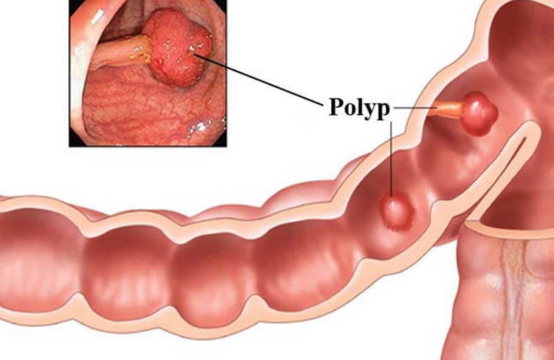 Chứng bệnh đi đại tiện ra máu tươi nhỏ giọt là gì và cách điều trị? 2