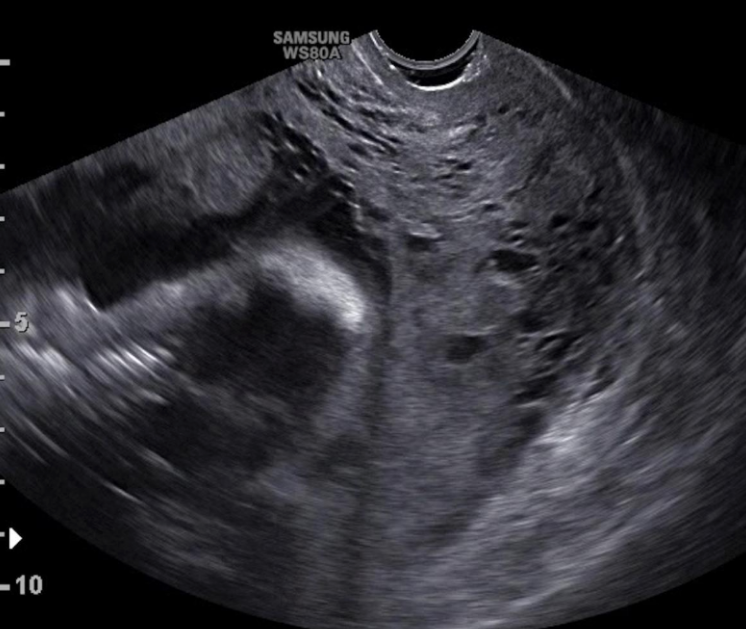 Có phát hiện được rau cài răng lược trên siêu âm không? 3