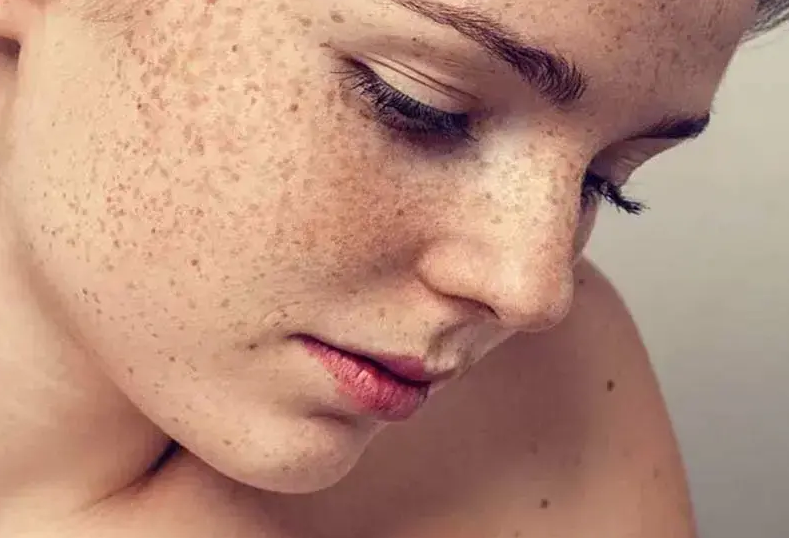 Da bị tăng sắc tố sau peel là hiện tượng gì? Có khắc phục được không? 3