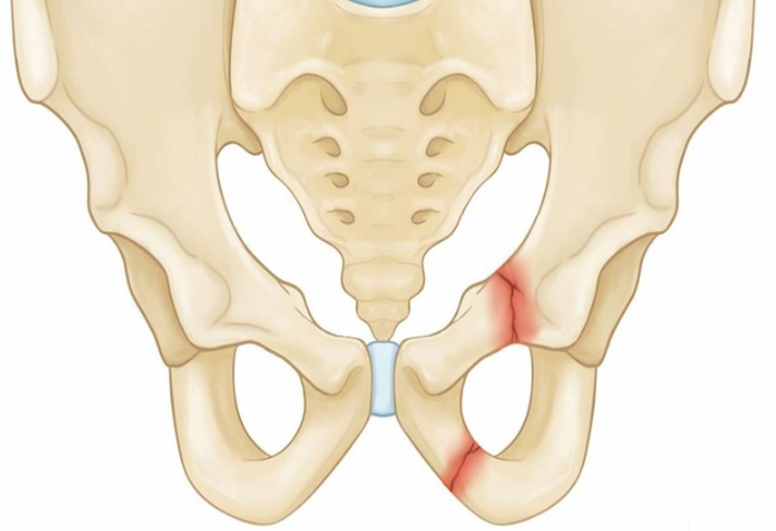 Đám rối thần kinh thắt lưng là gì? Cách điều trị như thế nào? 1