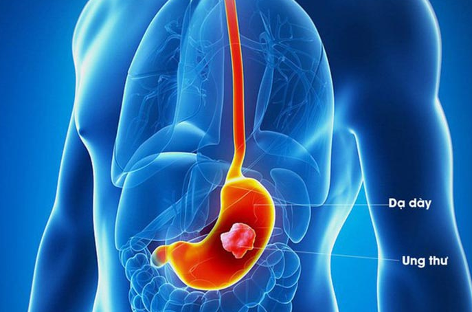 Đau dạ dày buồn nôn hay đau bụng buồn nôn, thuật ngữ nào đúng? 2