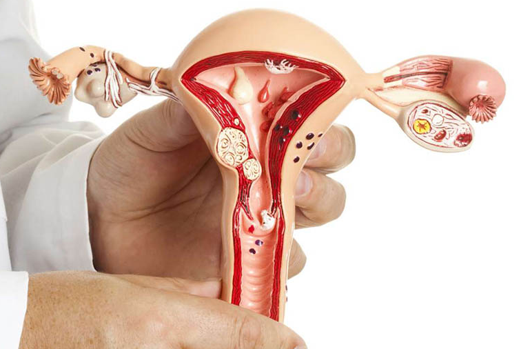 Dấu hiệu lạc nội mạc tử cung là gì? 1