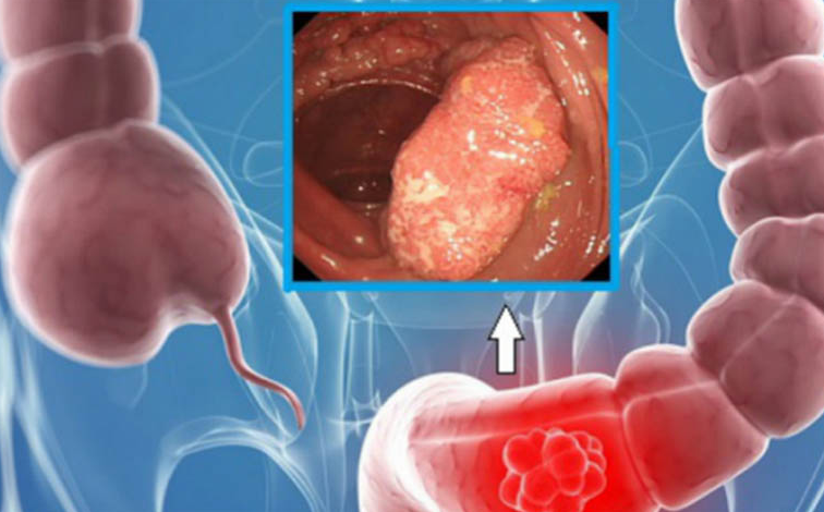 Đi ngoài ra máu và chất nhầy là bệnh gì? Cần điều trị ra sao? 2